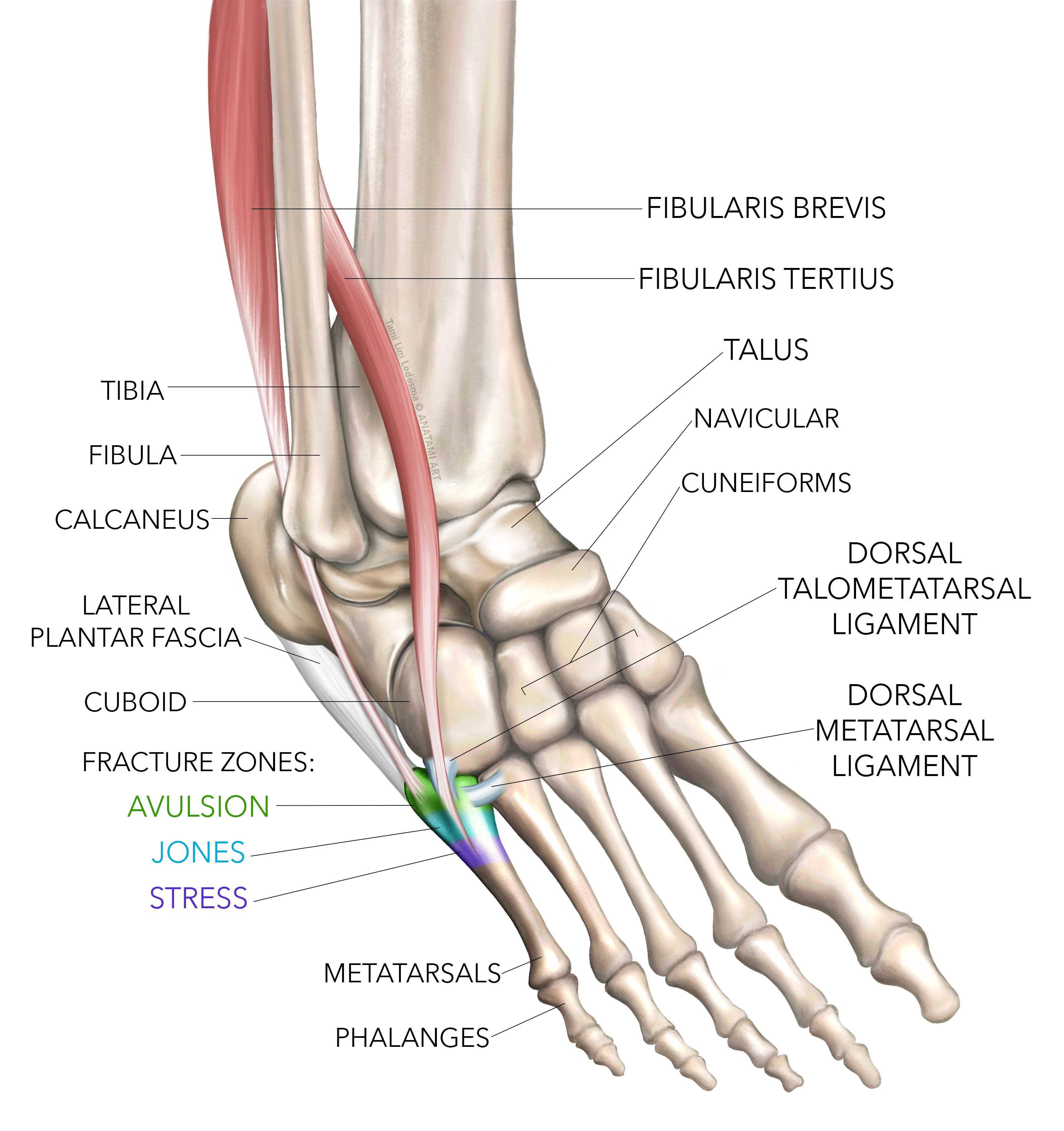 th-metatarsal-fractures-assessment-the-best-porn-website