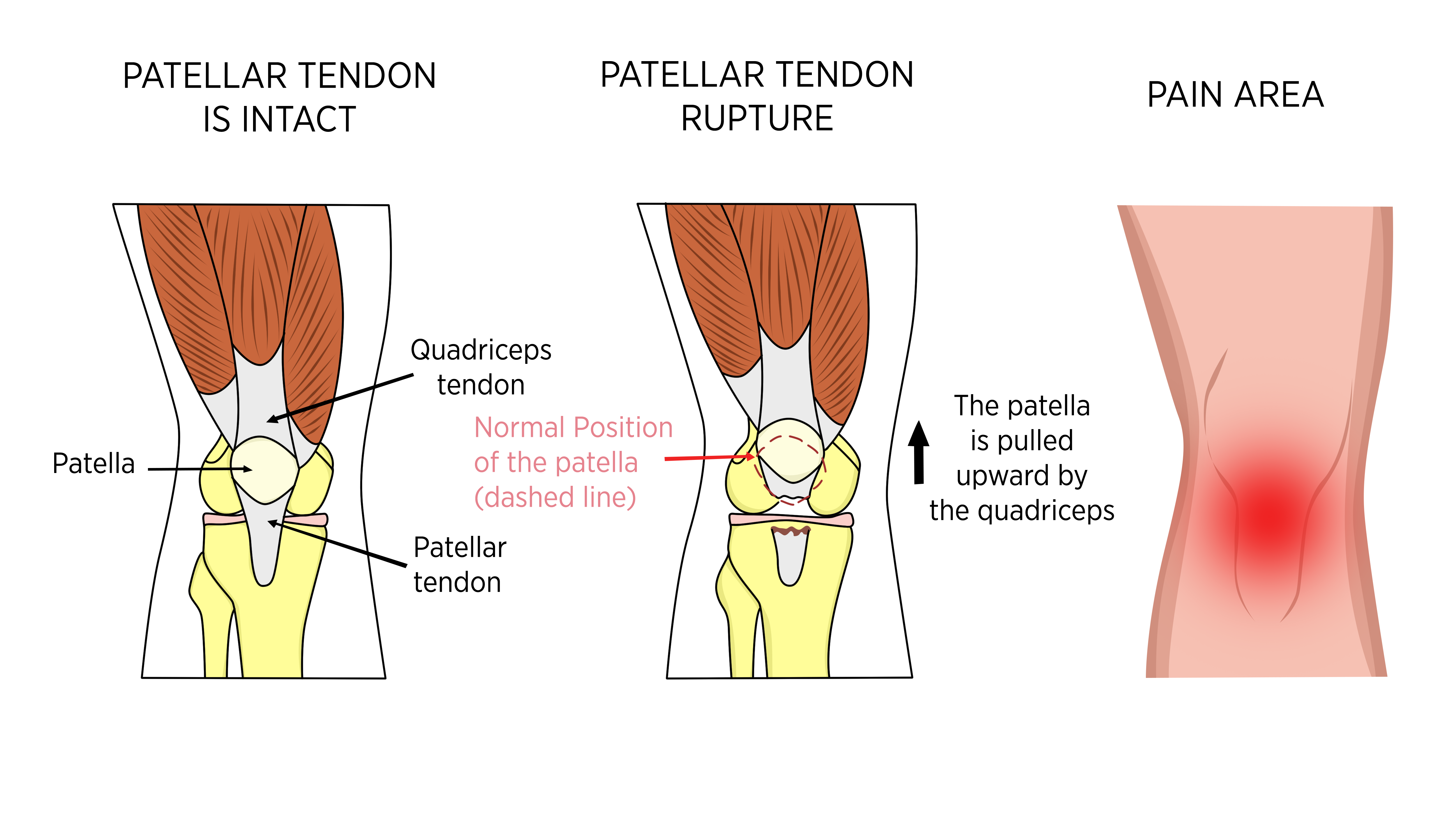 Sports Injury Bulletin Diagnose & Treat A hop, skip, and a jump