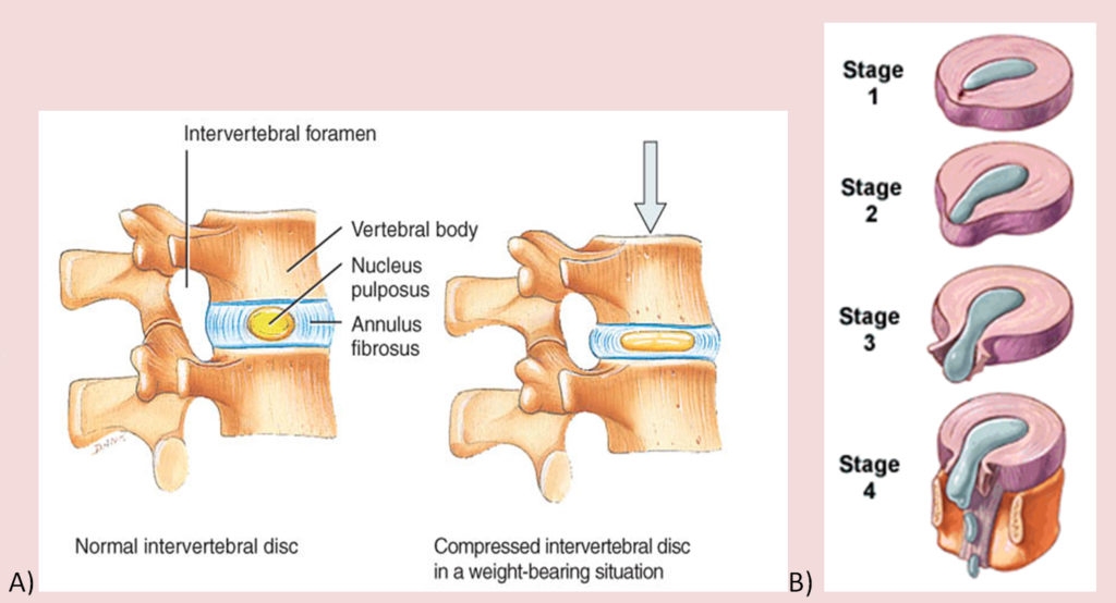 Sports Performance Bulletin - Injuries & health - Neural tension: don't ...