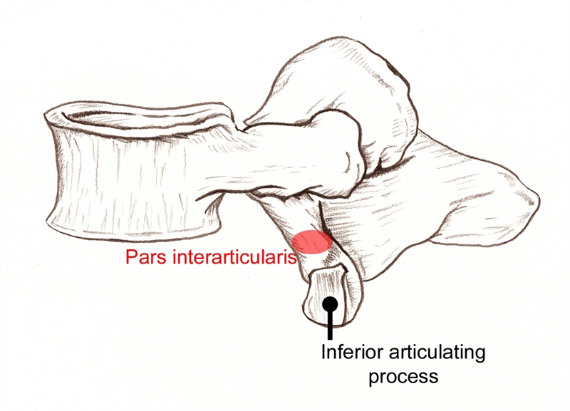Sports Injury Bulletin Diagnose & Treat Lumbar spondylolysis in