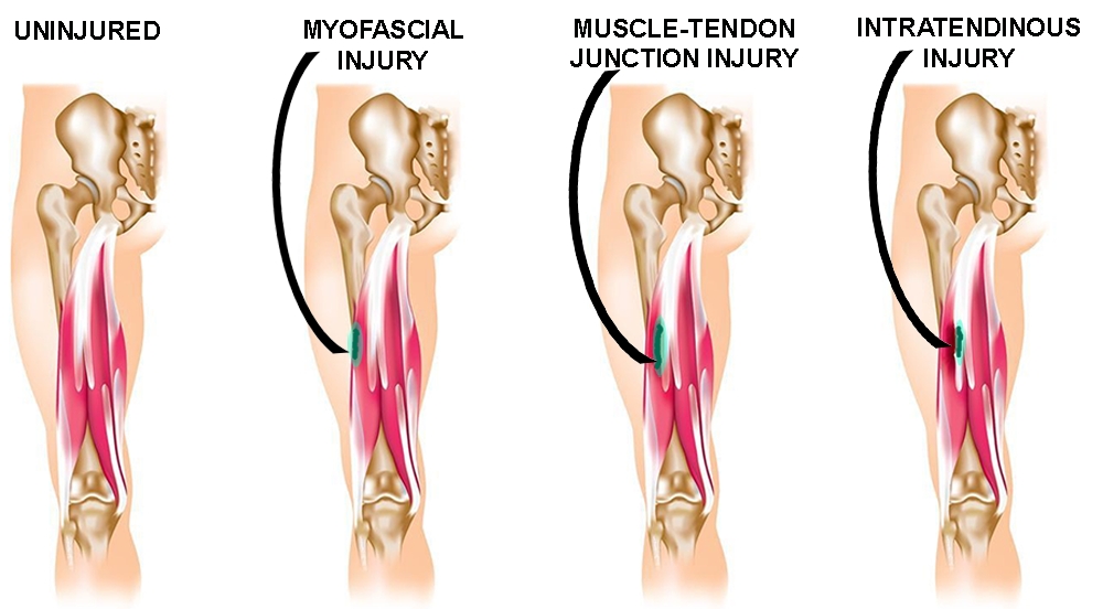 Sports Injury Bulletin - Anatomy - Hamstring injuries: why location and ...
