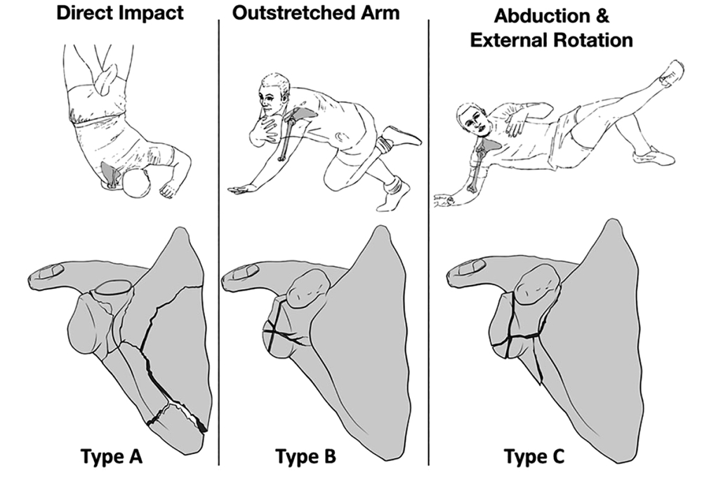 Scapular Fractures Diagnosis And Treatment Plan vrogue.co