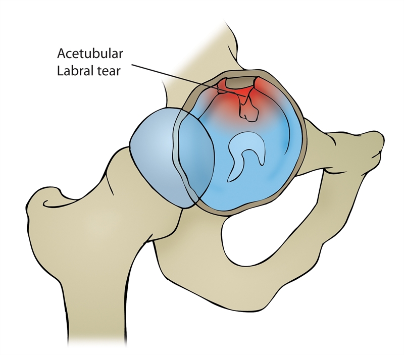 Sports Injury Bulletin Diagnose Treat Assessing And Managing Acetabular Labral Tears