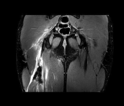 biceps femoris tendon mri