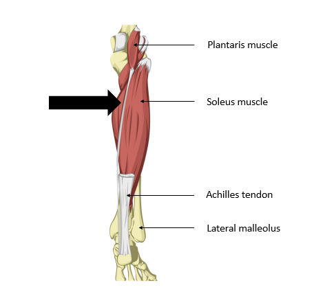 Sports Injury Bulletin - Diagnose & Treat - Posterior heel pain: the Physiotherapist's Achilles ...