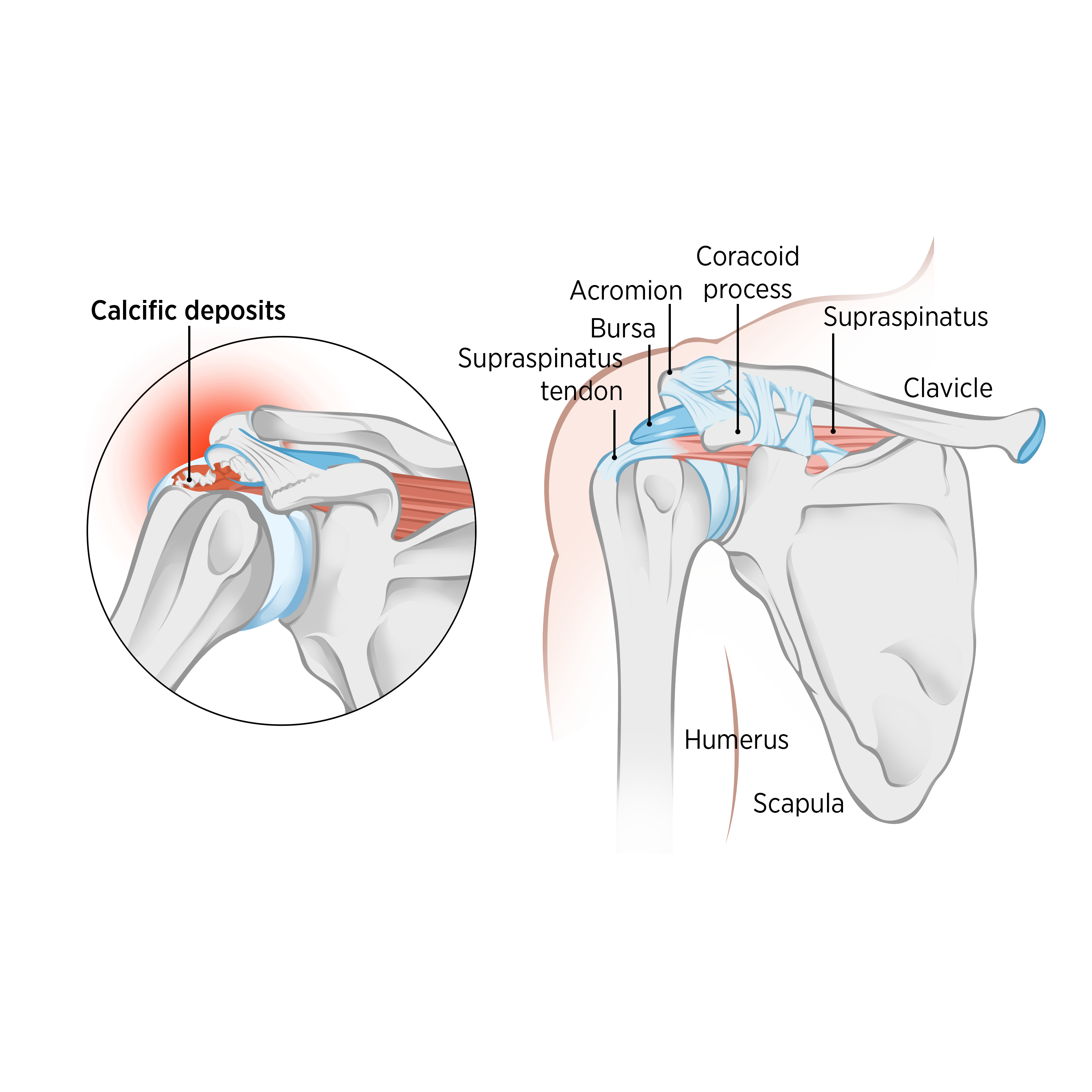 Sports Injury Bulletin - Anatomy - Calcific Tendonitis Of The Shoulder