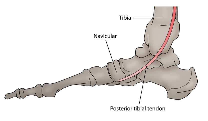 Figure 2: Medial aspect of the foot/ankle complex demonstrating the tibias posterior tendon.