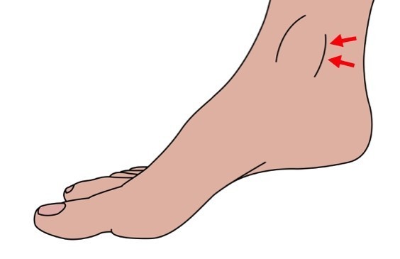Figure 3: Swelling of the tibialis posterior tendon behind the medial malleolus of the ankle.