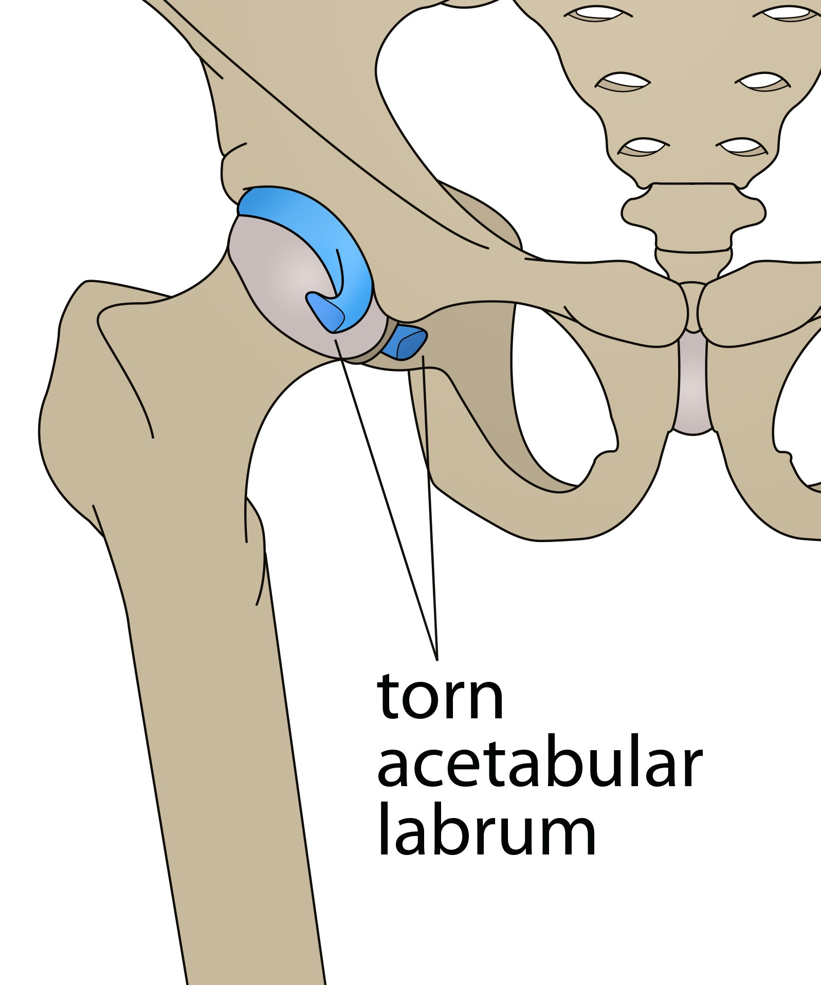 Figure 1a: Hip joint showing the femoral head (the end of the thigh bone) connecting to the acetabulum (the socket), where a tear to the labrum is detailed. Figure 1a: Hip joint showing the femoral head (the end of the thigh bone) connecting to the acetabulum (the socket), where a tear to the labrum is detailed.