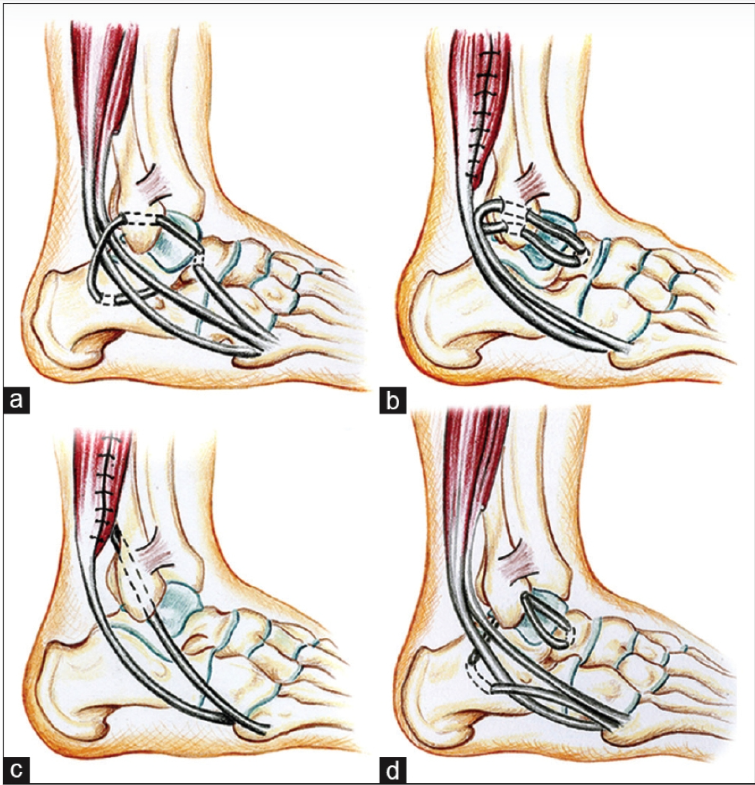 Figure 2: Common surgical variations. (a) Watson Jones (b) Evans (c) Chrisman Snook (d) Colville (from Al-Mohrej and Al-Kenani 2016 (39)). Figure 2: Common surgical variations. (a) Watson Jones (b) Evans (c) Chrisman Snook (d) Colville (from Al-Mohrej and Al-Kenani 2016 (39)).