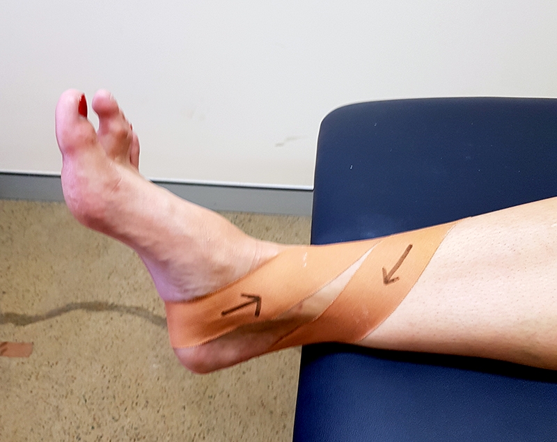 Figure 3: Taping or strapping to limit movements of the subtalar joint and the midfoot.
