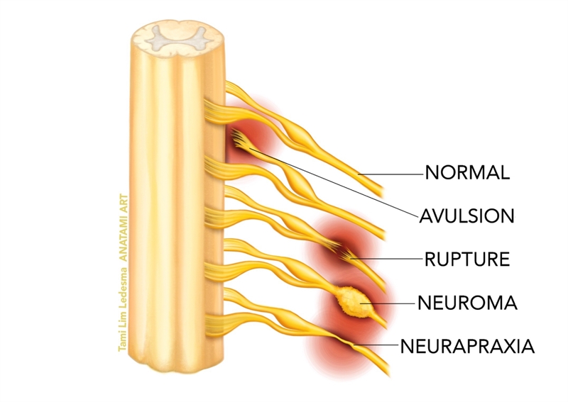 Figure 1: Types of brachial plexus injury.